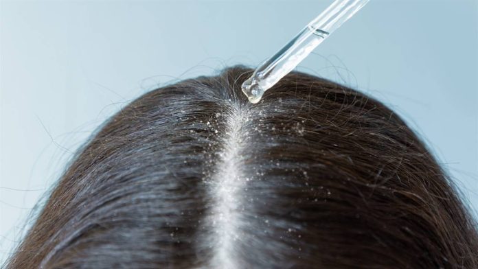 Is removing dandruff in a day possible How to remove it with natural remedies