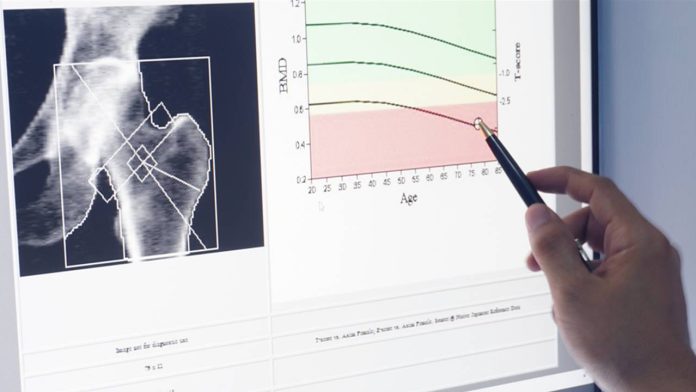 Osteoporosis what it is, symptoms and how to prevent it